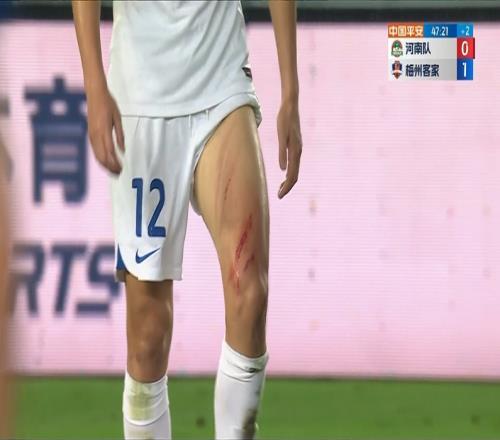 对抗激烈!尹聪耀大腿上四道血痕清晰可见!