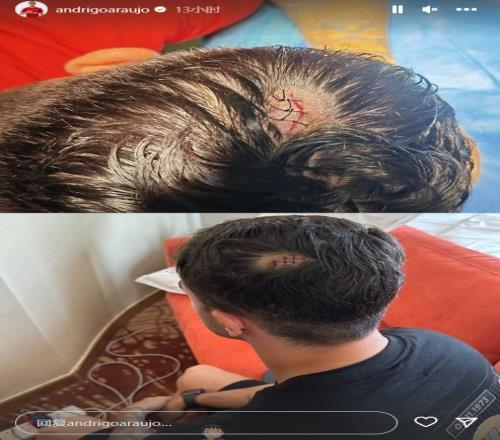 看着都疼!蓉城外援安德里戈社媒晒脑袋缝针照