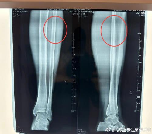 伤情报告:王刚左小腿中上段腓骨裂纹骨折