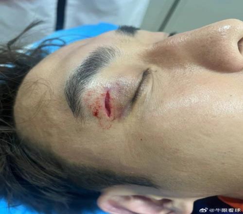 被肘击后带伤作战!记者:吴兴涵赛后缝了18针