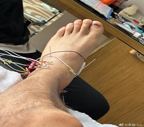 李磊社媒晒治伤照:有时也不知在坚持什么,可路就是这样走过来的