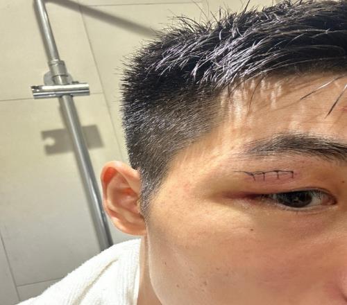 海港中卫魏震社媒晒伤口缝针照:不容易!让我们团结在一起!
