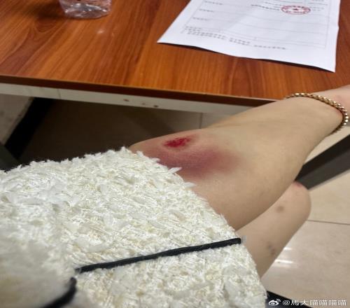 啥情况女子深夜晒受伤照怒喷贺惯:还是人吗一次次伤害我