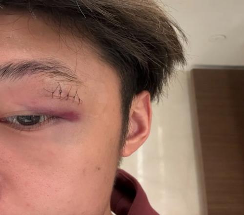 记者:徐皓阳带伤参加国足昨晚训练眉骨伤口较深缝合了5针